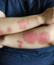 Eczema