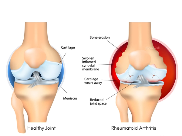 What causes Rheumatoid Arthritis
