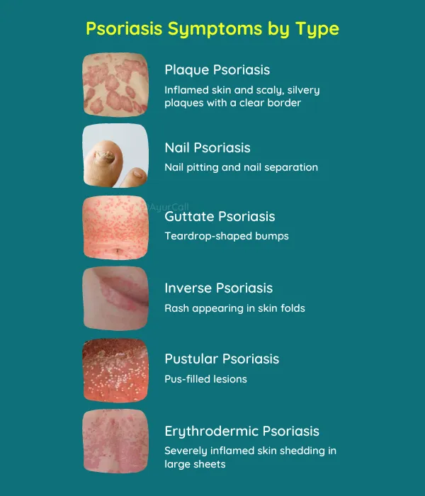 Psoriasis Symptoms by Type